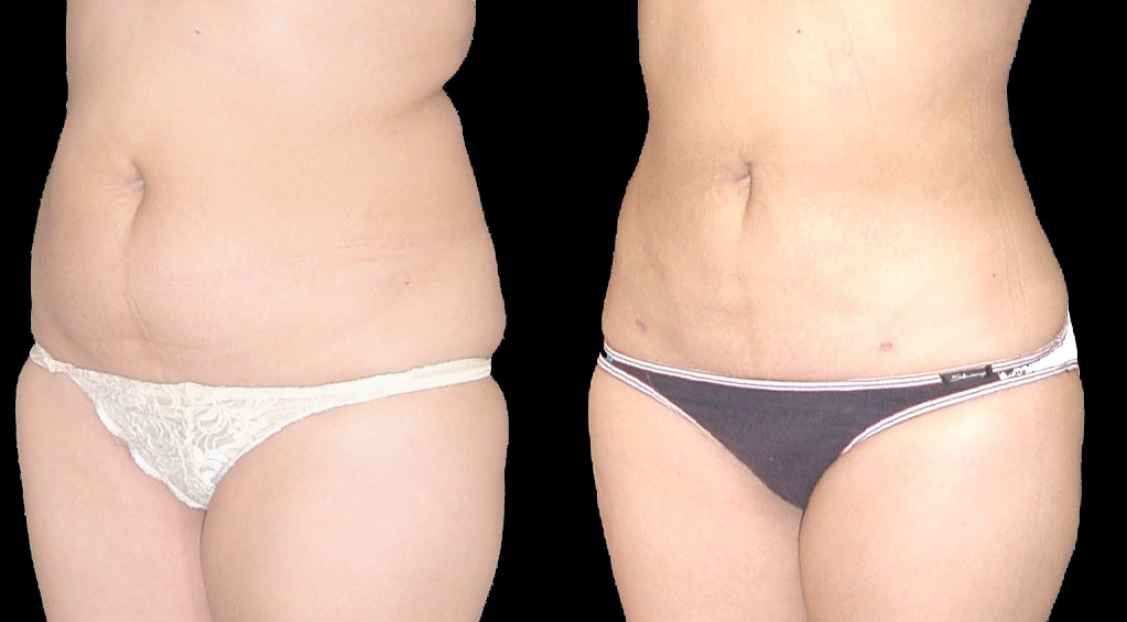 Next Gen Liposuction To Propel Expansion